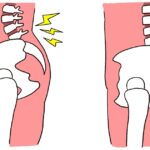 反り腰と通常の骨盤の位置を比較したイラスト