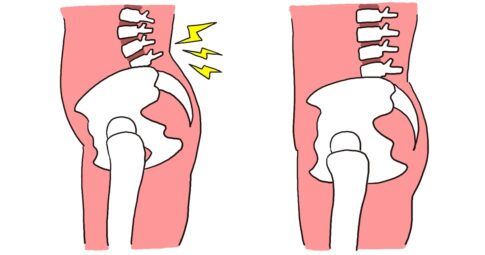 反り腰と通常の骨盤の位置を比較したイラスト