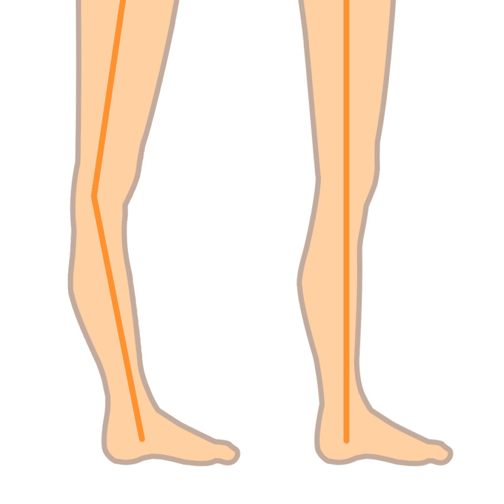 反張膝、過伸展と正常の膝の比較